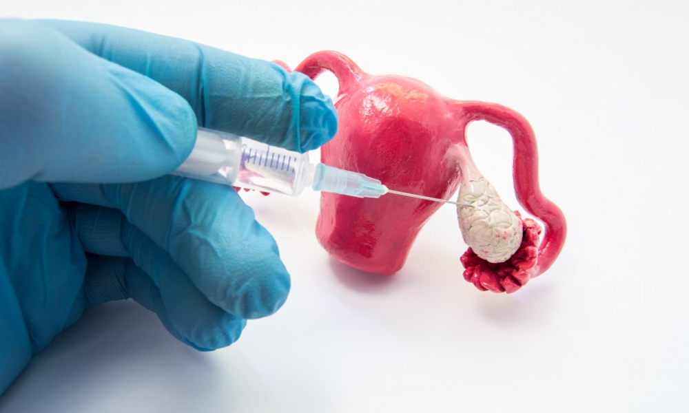 Ovulation Induction Treatment in Pune